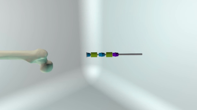 Implante intramedular